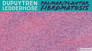 Palmar Fibromatosis Dupuytren Contracture amp Plantar Fibromatosis 5Minute Pathology Pearls [upl. by Aneed86]