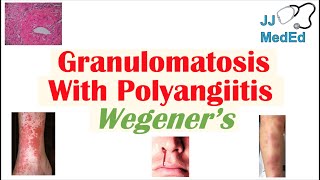 Granulomatosis with Polyangiitis Wegener’s granulomatosis  Symptoms Diagnosis Treatment [upl. by Sedberry]