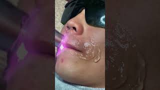 Diode Laser Hair Removal Permanent [upl. by Noryk772]