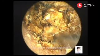 Left lateral auditory canal cholesteatoma clearance process clip 18 minutes [upl. by Isidoro]