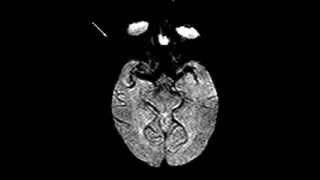 Normal brain perfusion [upl. by Attela]