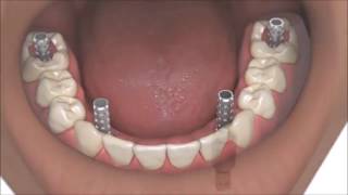 AllOn4 Dental Implants Coventry Best Same Day Full Whole Mouth Teeth Implants At Verum Dentists [upl. by Peisch]