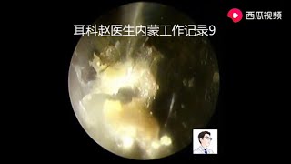 Cleaning cholesteatoma of external auditory canal and tympanic enucleation with otoendoscopy [upl. by Fregger]