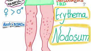 Erythema Nodosum [upl. by Nallek229]