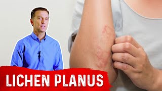 Lichen Planus Best Remedy [upl. by Yt]