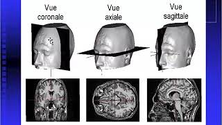 EXPLORATIONS NEURO RADIOLOGIQUES DIAGNOSTIQUES CRANIO ENCEPHALIQUES [upl. by Retep]