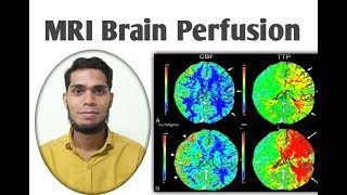 MRI Brain perfusion [upl. by Osrick]