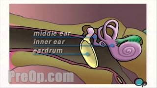 Myringotomy Insertion of Tube Surgery PreOp® Patient Engagement and Education [upl. by Sanchez]