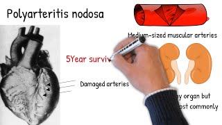 Polyarteritis nodosa made easy [upl. by Tatiania]