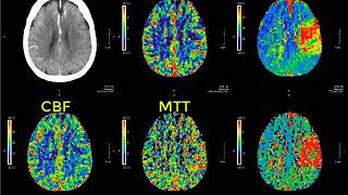 Introduction to CT perfusion before Call [upl. by Consuela]