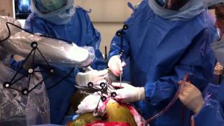 Total Hip Replacement Using MAKO Robotic Assistance [upl. by Drexler]