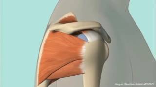 Chronic Subacromial Impingement Animation [upl. by Acinoreb]