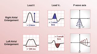 Intro to EKG Interpretation  Chamber Enlargement [upl. by Lyudmila]