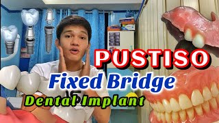 PUSTISO  Fixed  removable and Implant Pamalit sa nabunot na ngipin [upl. by Lapides]