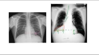 🔴 PNEUMONIE PLEURESIE INFARCTUS OU ATELECTASIE [upl. by Mac994]