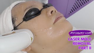 Laser Hair Removal Diode Laser Hair Removal 808nm Laser Painless myChway GX002 Part II Face [upl. by Melodee]