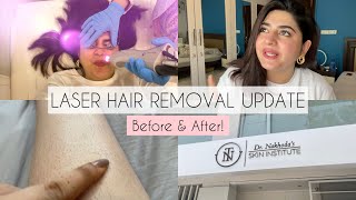 Full Body Laser Hair Removal Update  Does it Make a Difference GlossipsVlogs [upl. by Erund]