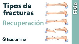 Tipos de FRACTURAS de hueso y su tratamiento y recuperación [upl. by Sidnal]