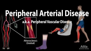 Acute Complete Occlusion of the Leg Arteries [upl. by Noffets]